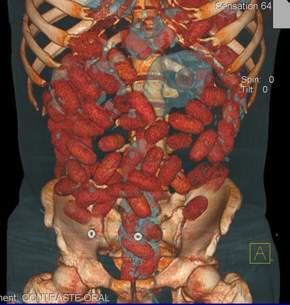 Asa arata 72 de bile de cocaina in intestinele unui om. Tomografii 3D - Imaginea 1