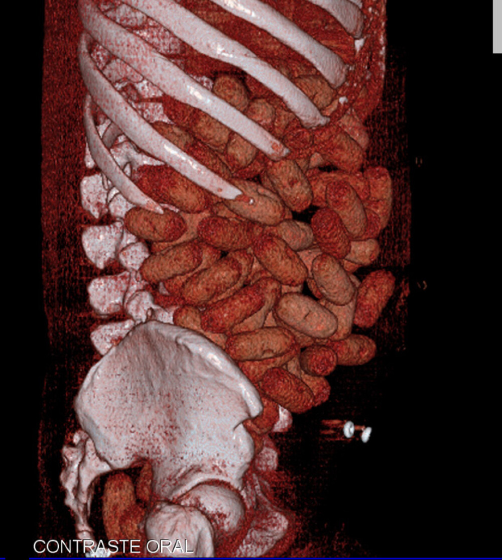 Asa arata 72 de bile de cocaina in intestinele unui om. Tomografii 3D - Imaginea 2