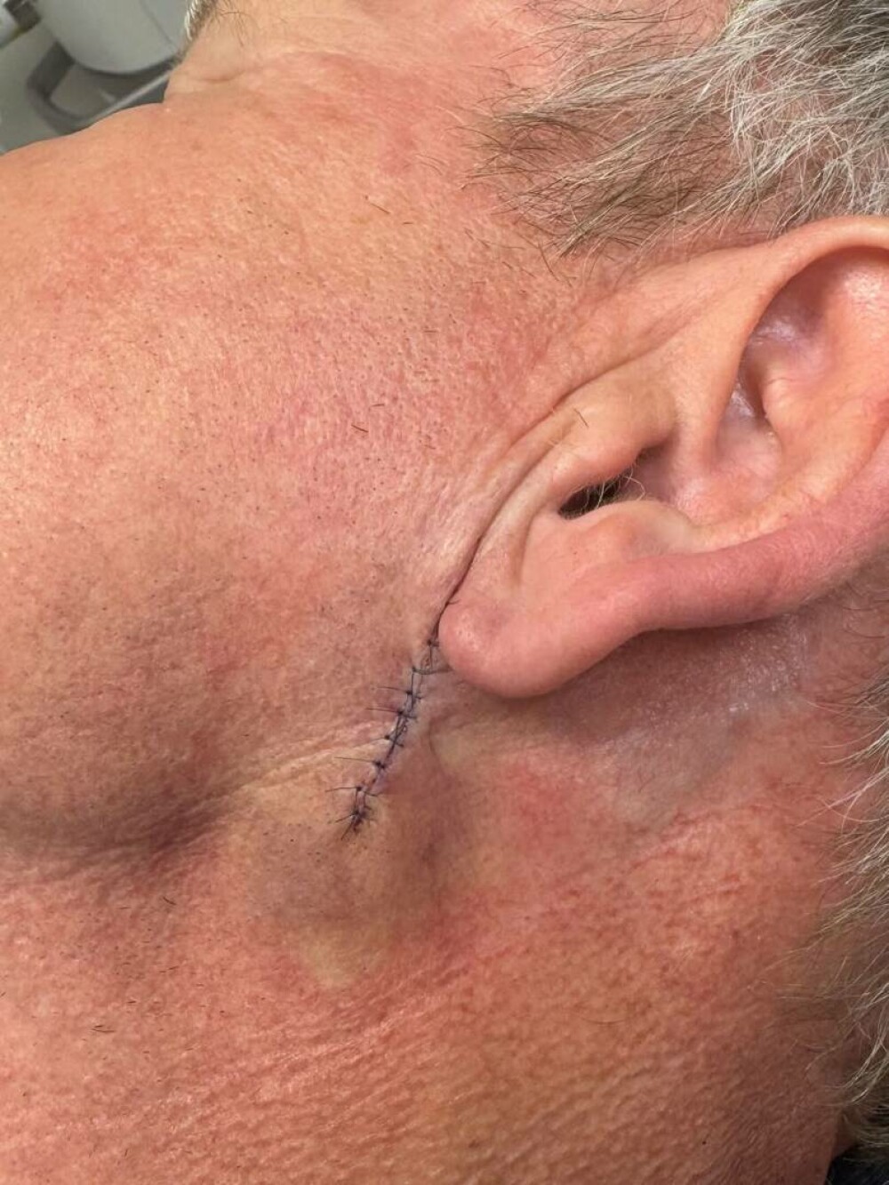 Gordon Ramsay a fost operat pentru cancer de piele. „Vă rog să nu uitaţi să vă daţi cu cremă de protecţie solară” - Imaginea 1