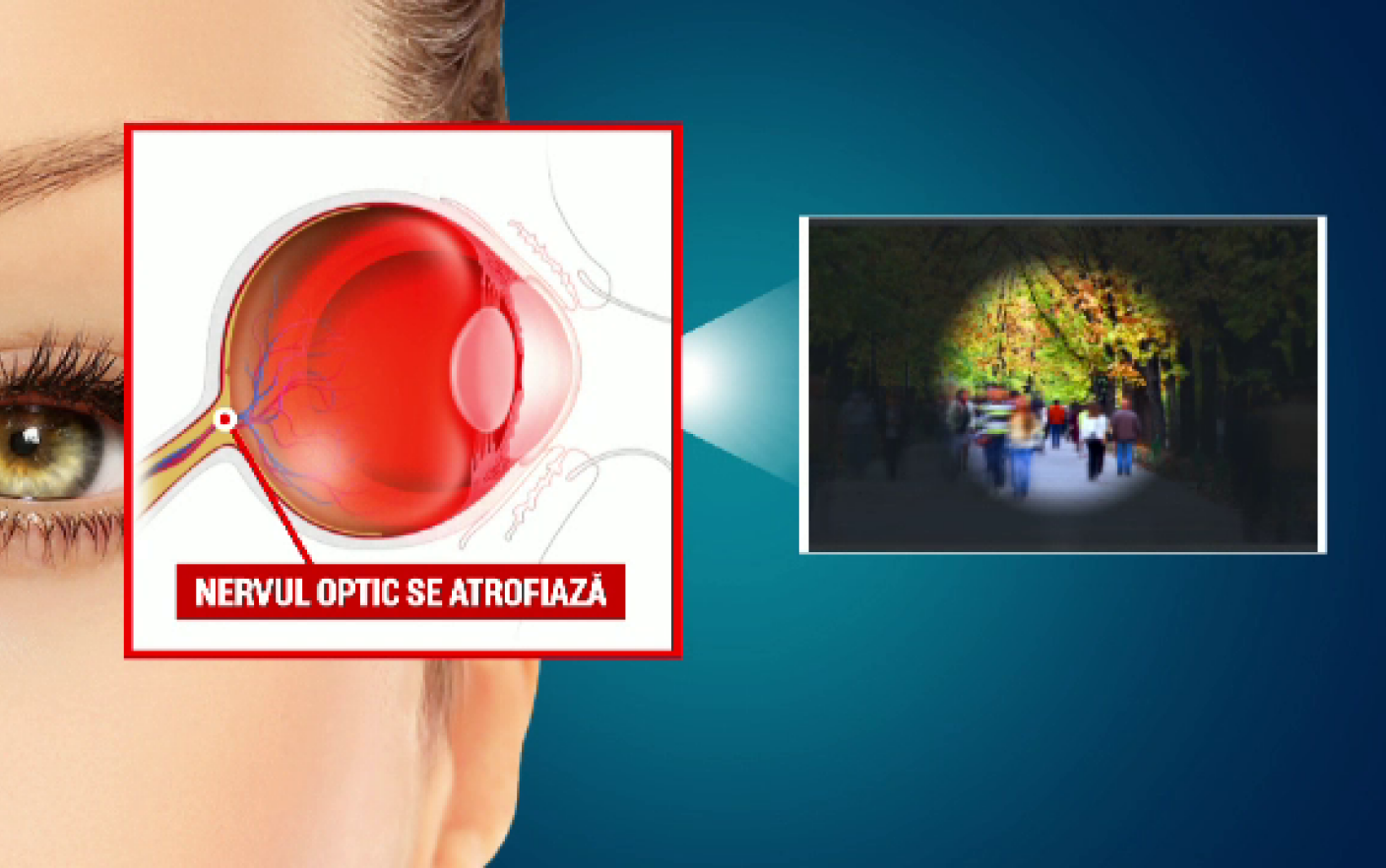 este posibil să salvați vederea cu glaucom)