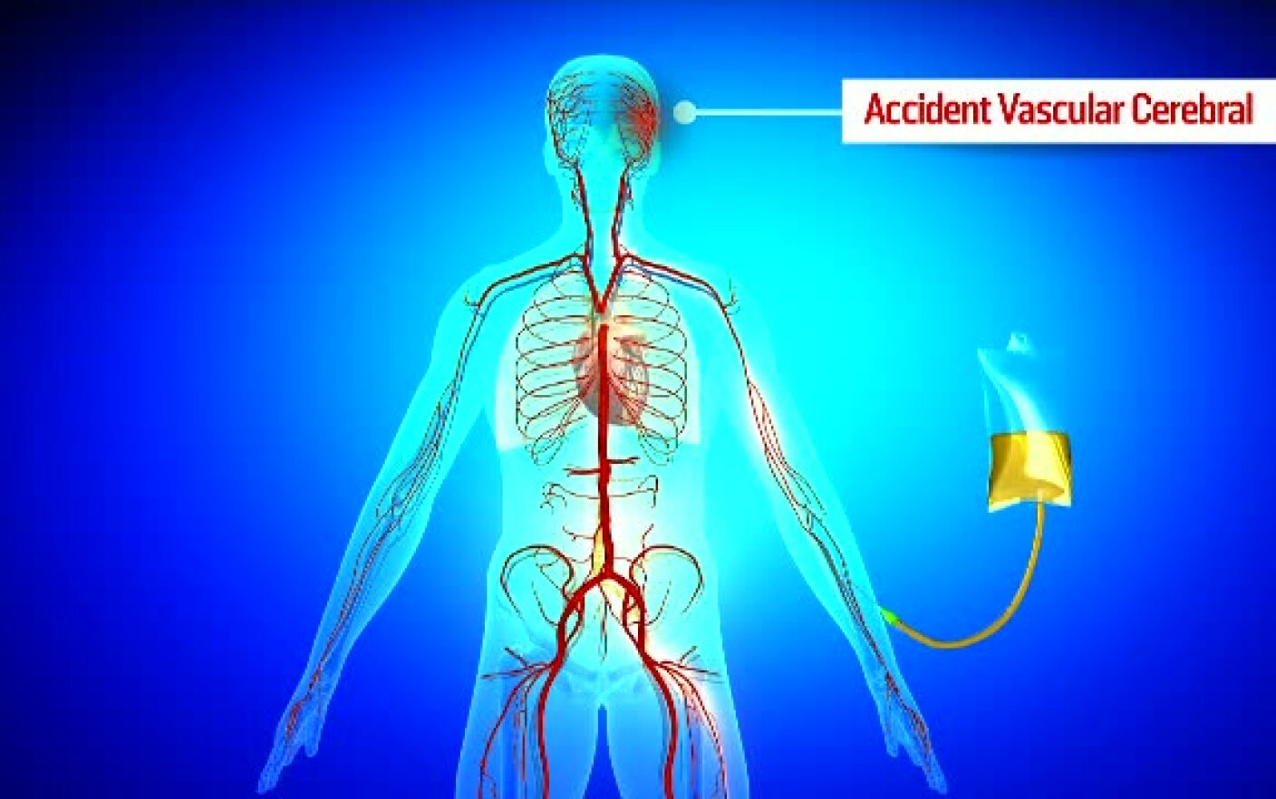 Accident vascular cerebral: Cauze si simptome ale infarctului cerebral | experttraining.ro