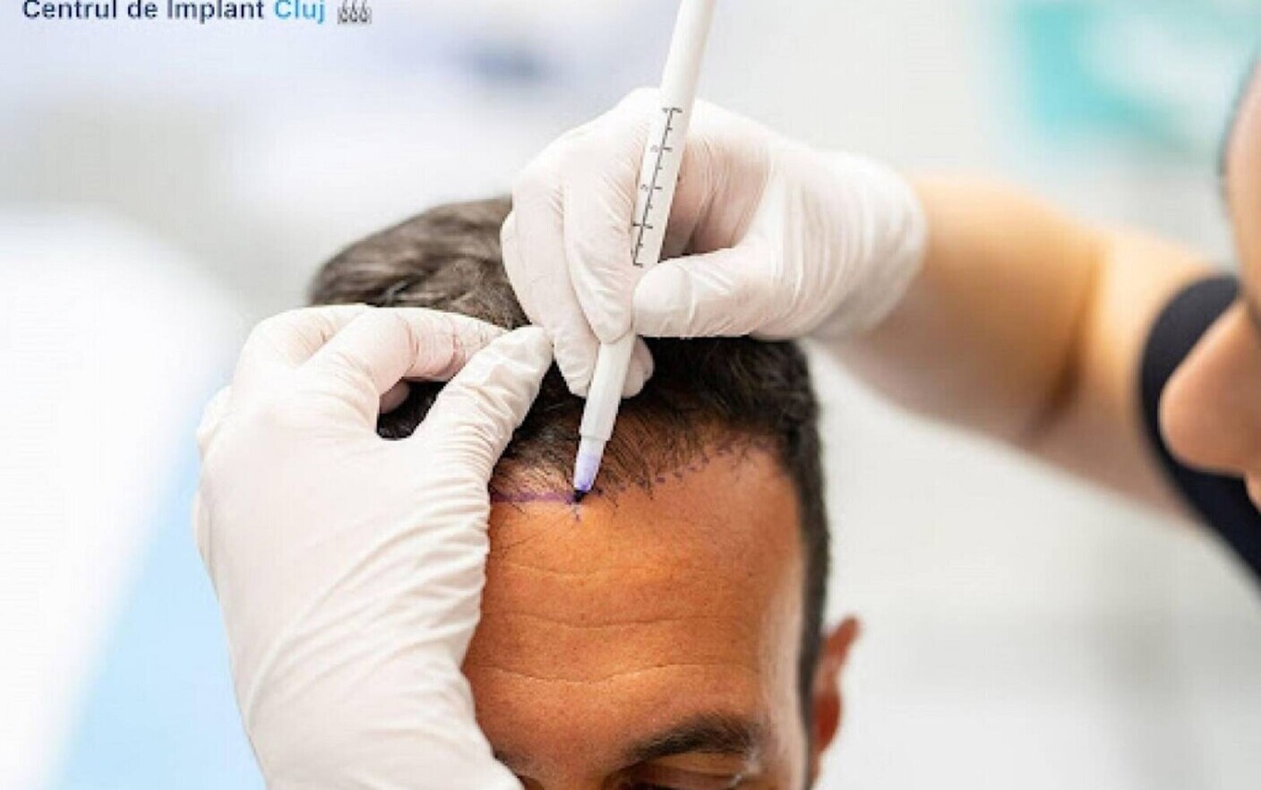 (P) Este implantul de păr permanent și cât costă?