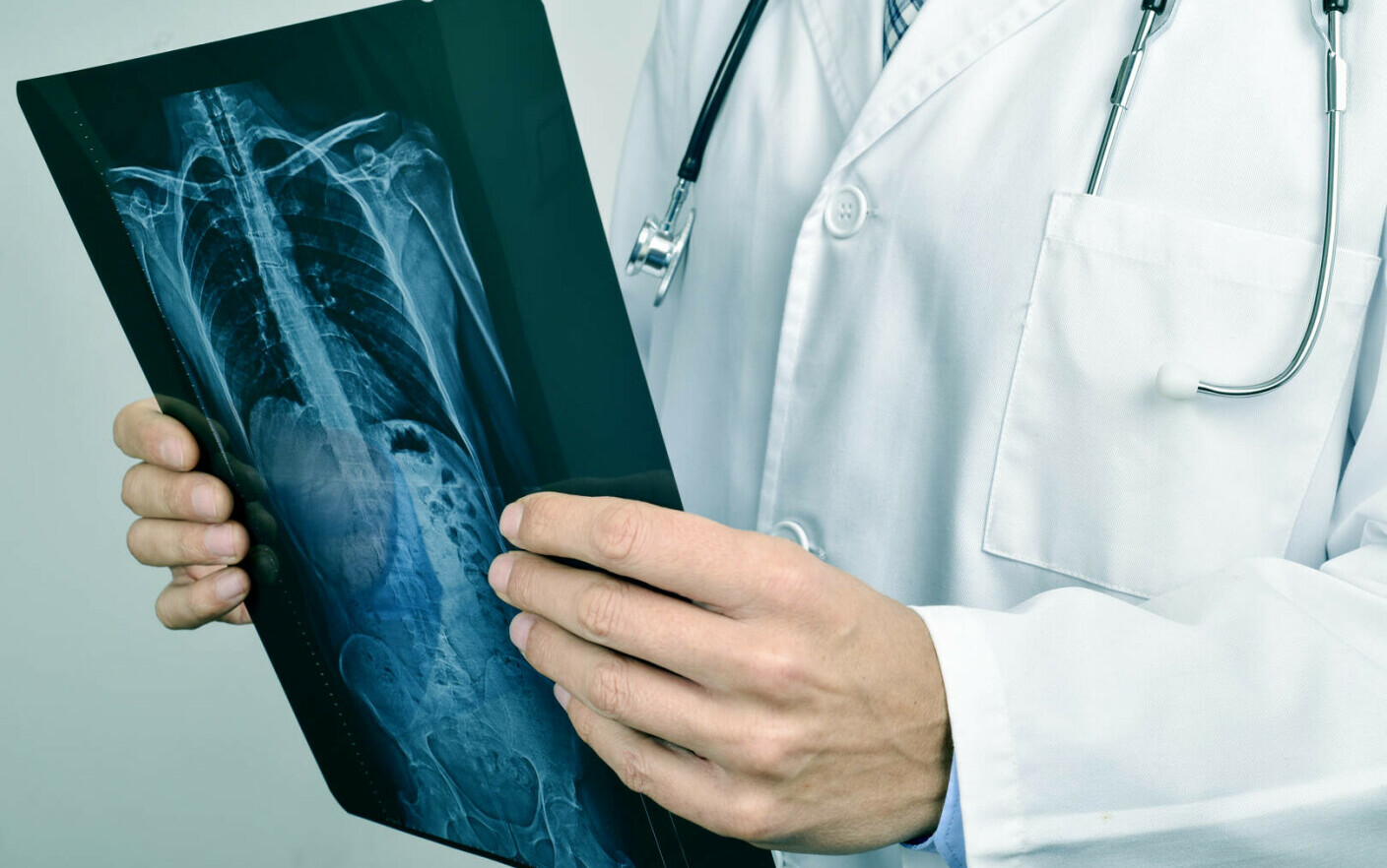 The Destructive Effects of Too Much Sugar on Kidneys and Blood Vessels