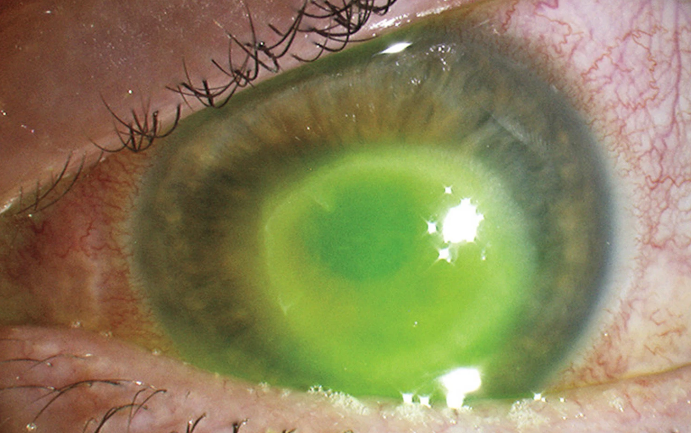 Tratamentul paraziților oculari la om. Descărcarea albă în semnele oculare ale helminților