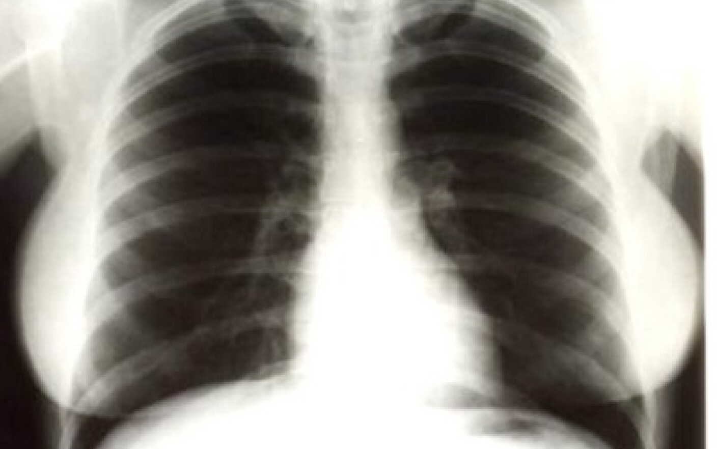 Radiografii pulmonare Marlyn Monroe