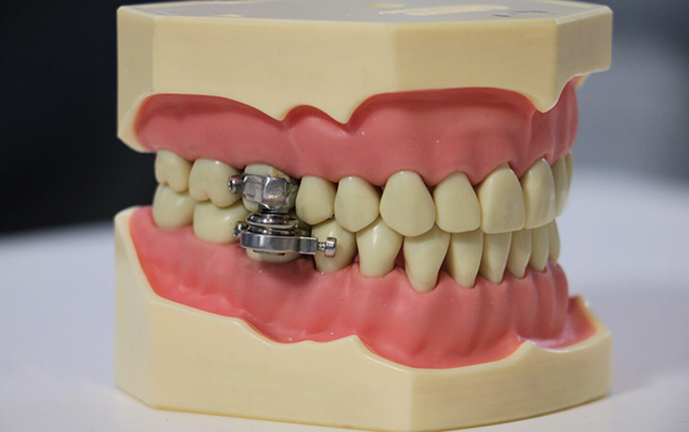 A fost creată o nouă metodă de a slăbi. Instrumentul împiedică deschiderea gurii mai mult de 2 mm