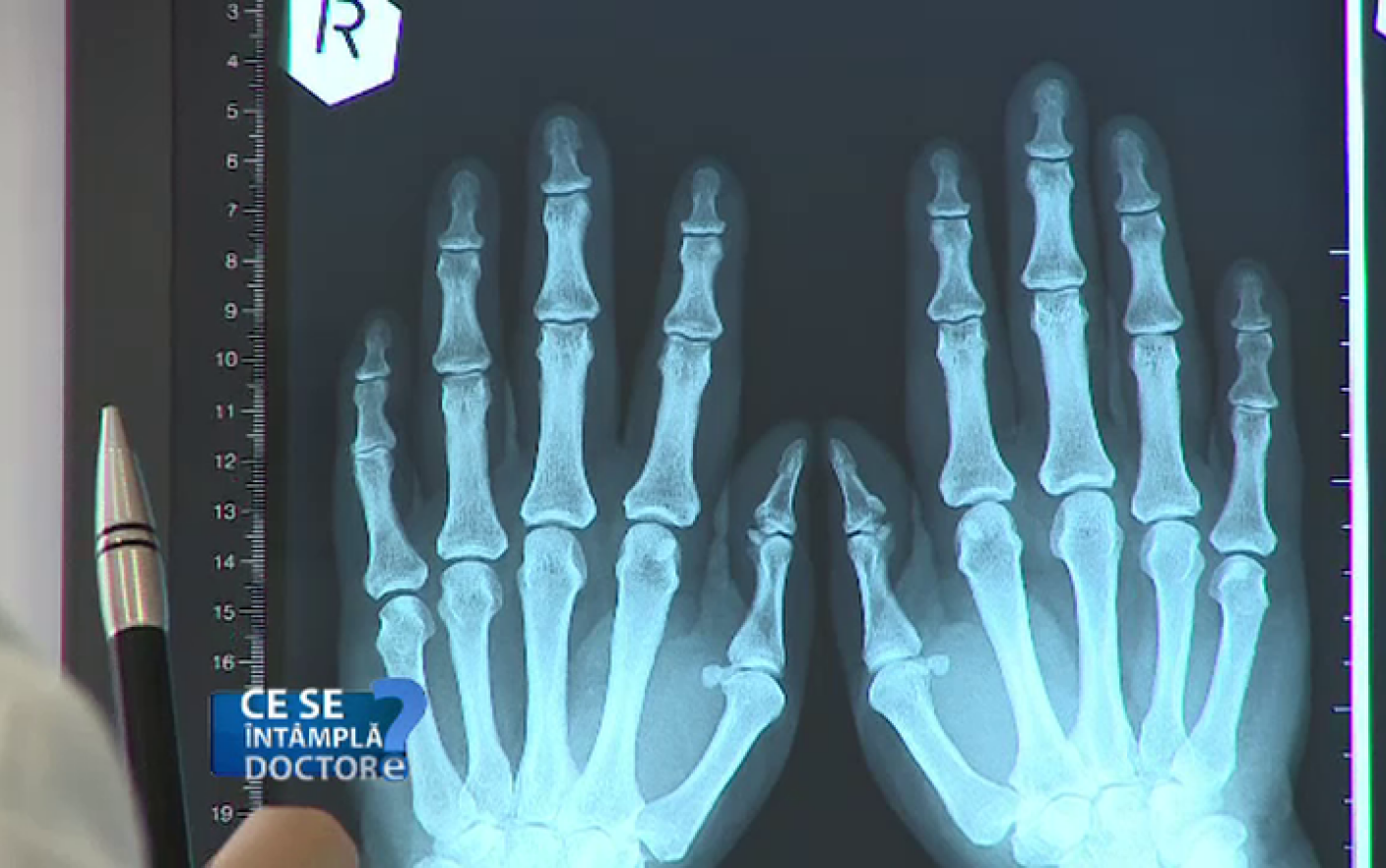 ce se întâmplă artrită mâini