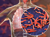 Numărul deceselor provocate de tuberculoză a crescut după o pauză de 10 ani. Cazurile de Covid îngreunează accesul în spitale