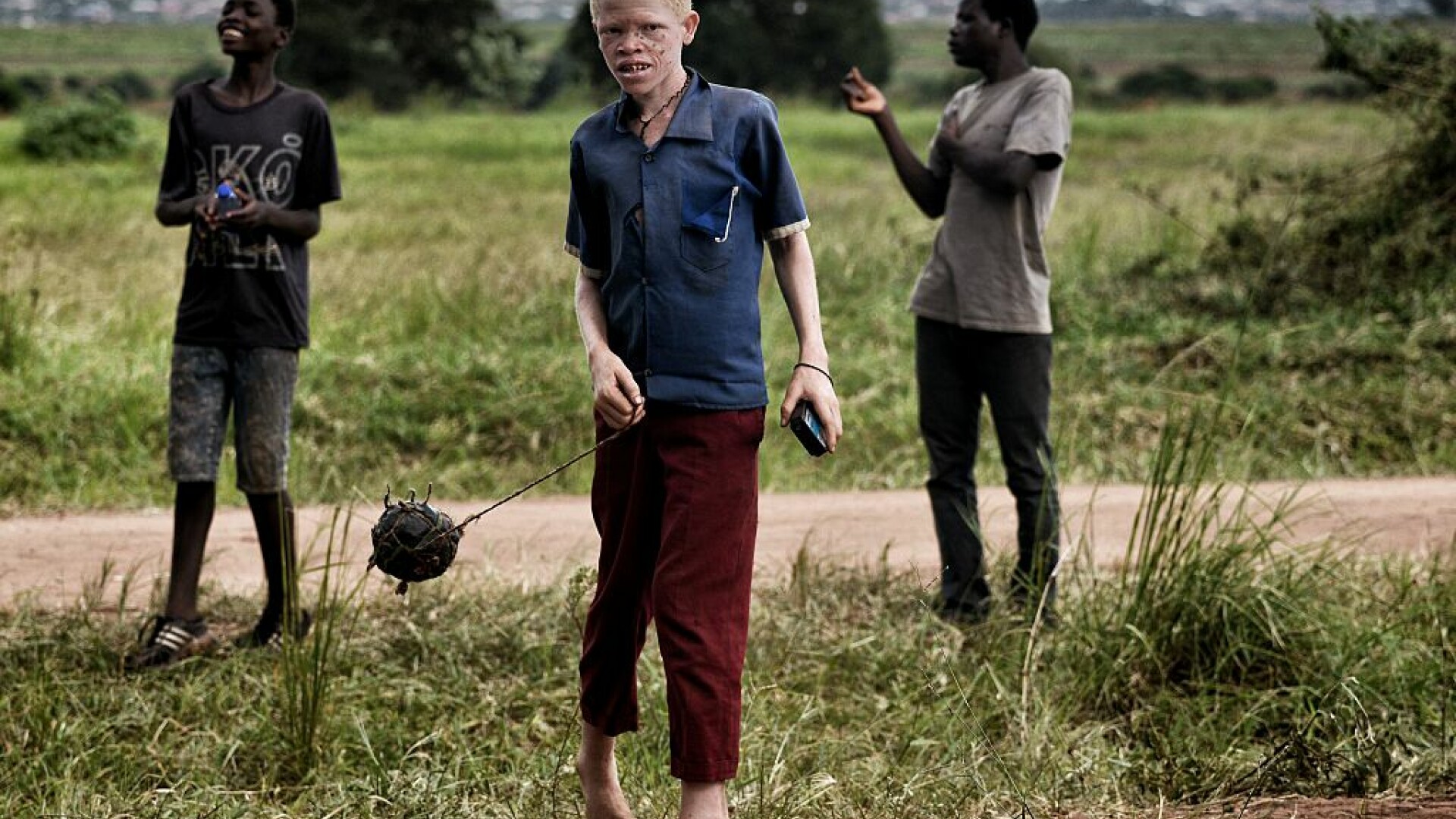 copil cu albinism din Malawi