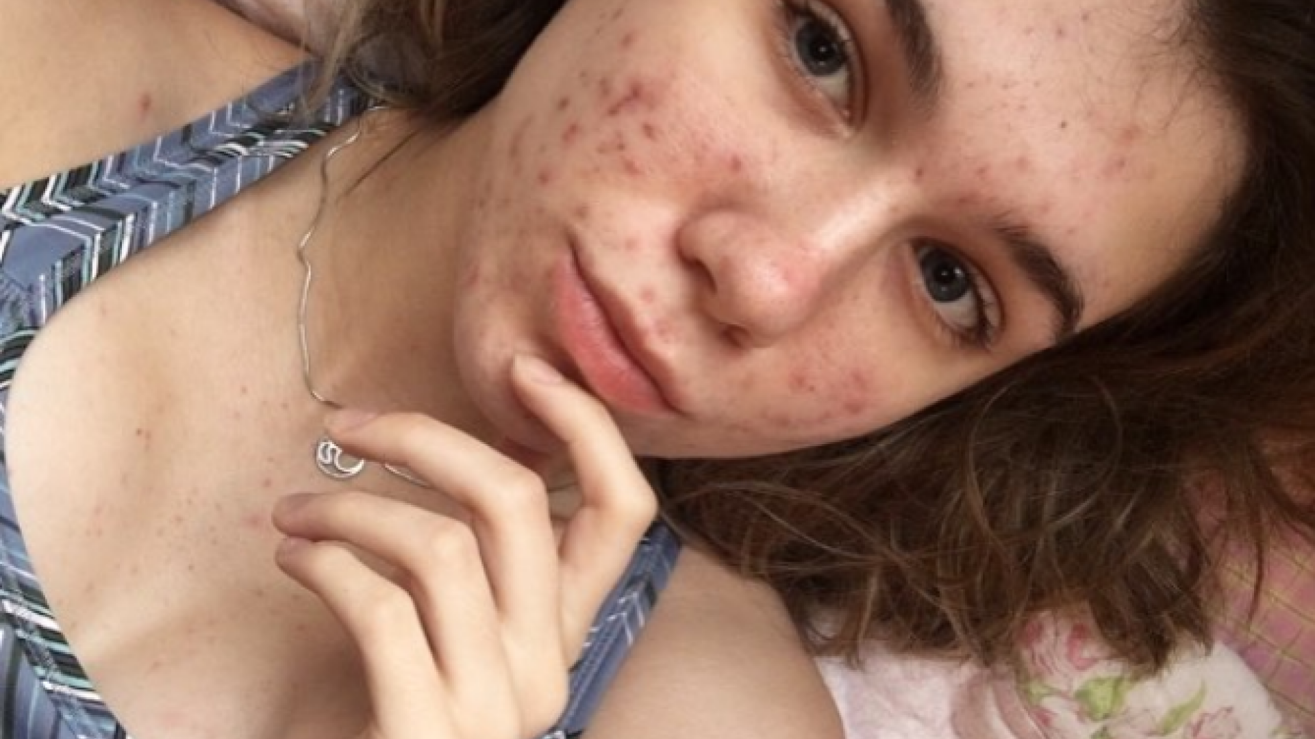 Adolescenta cu acnee