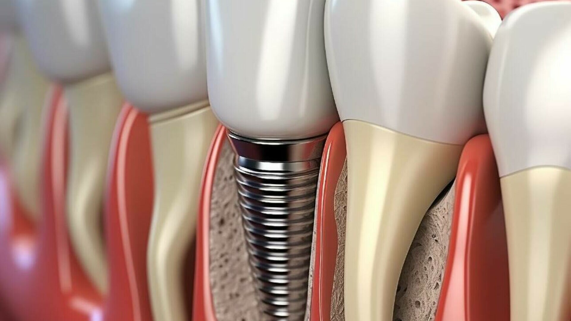 implant dentar