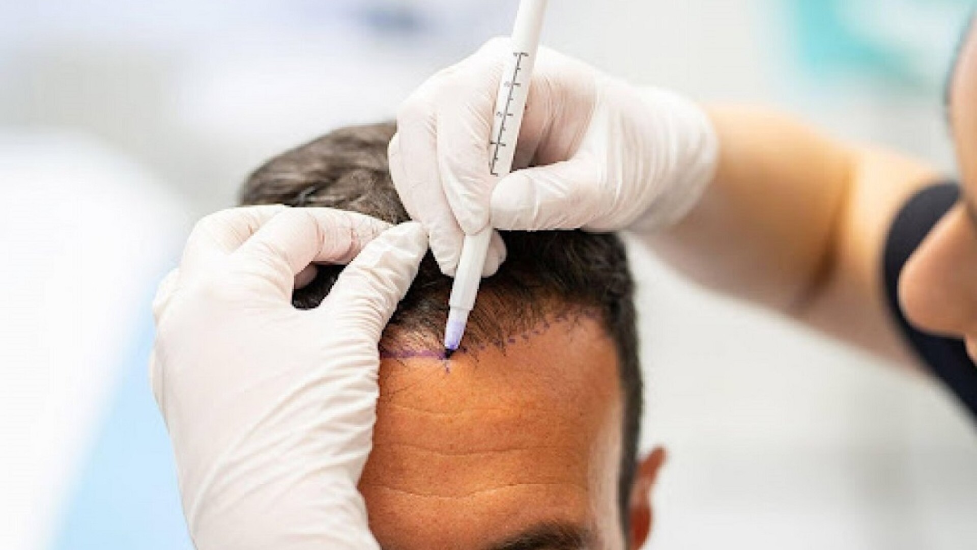 (P) Este implantul de păr permanent și cât costă?