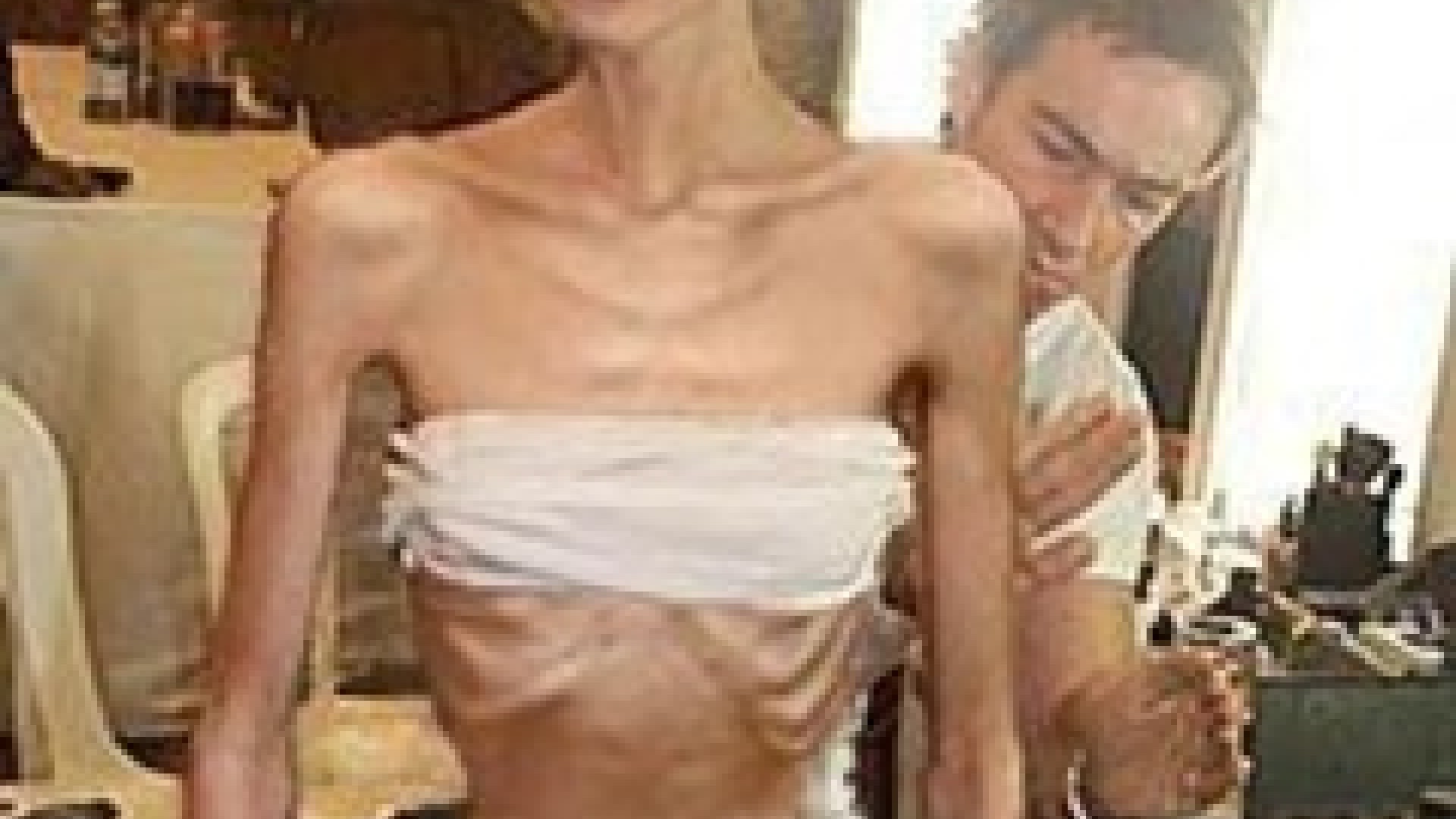 anorexice