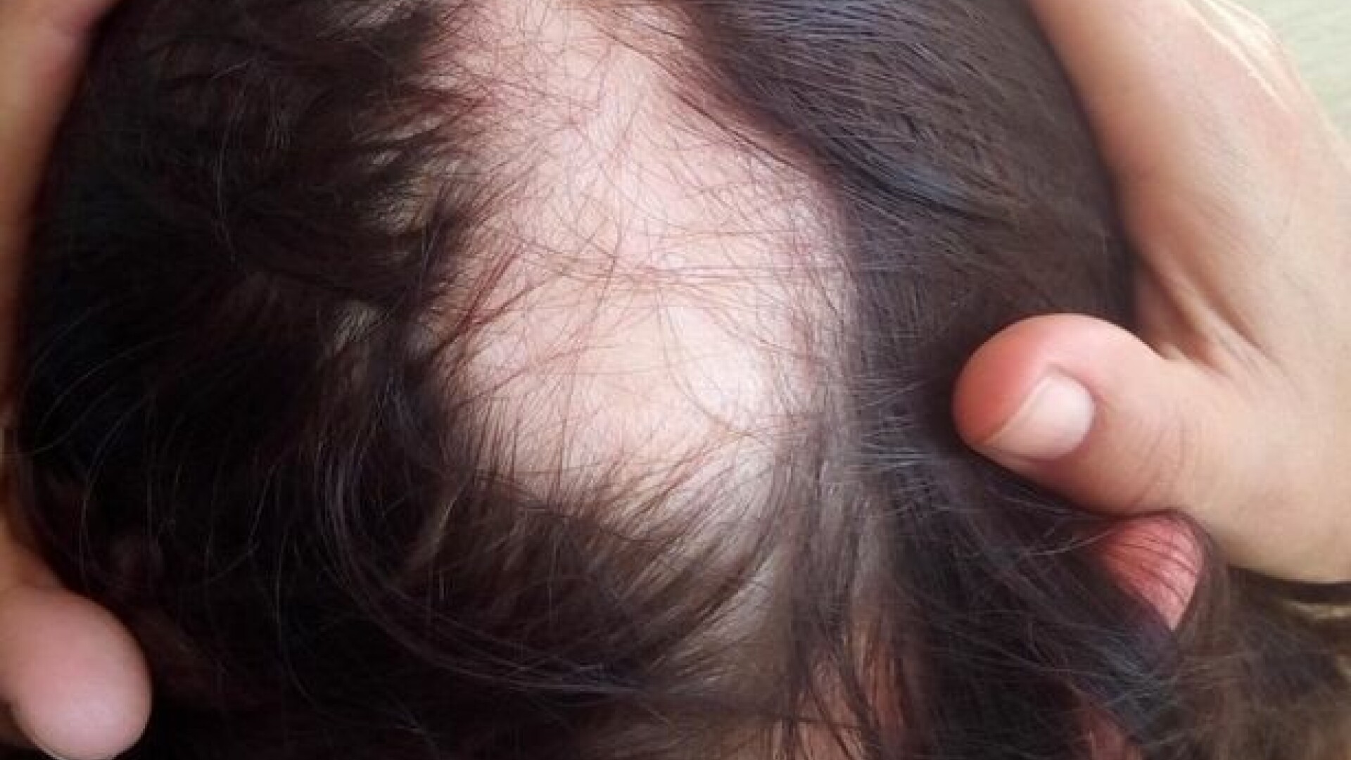 O femeie și-a pierdut o mare parte din păr din cauza COVID-19: 