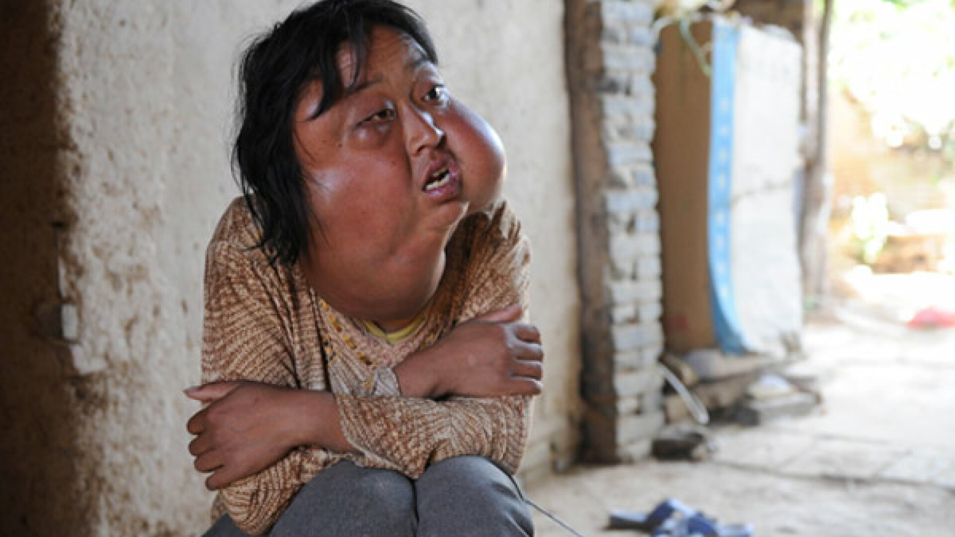 Li Honfang, femeie cu tumori pe fata