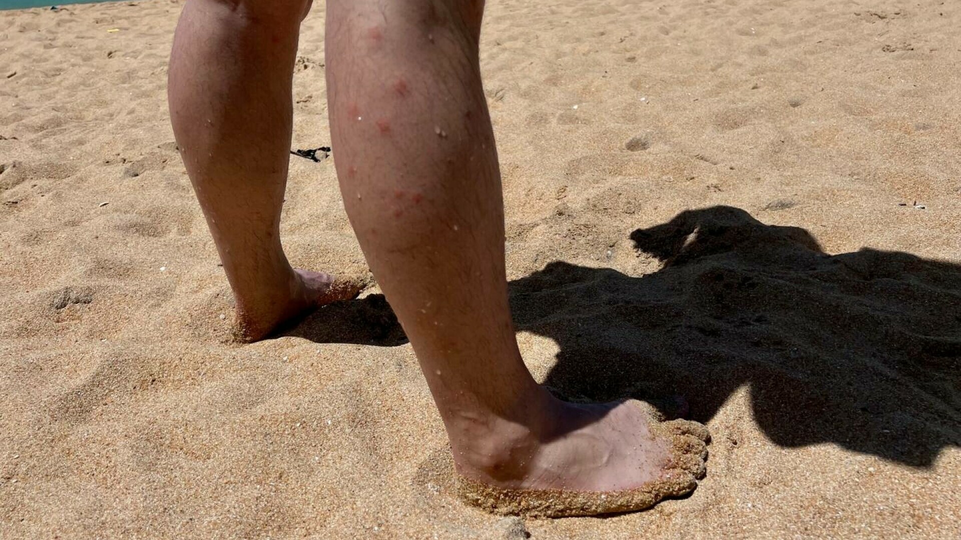 Cum să îți protejezi pielea de insecte vara la mare. Cum prevenim mușcăturile de insecte și ce folosim pentru a ne trata
