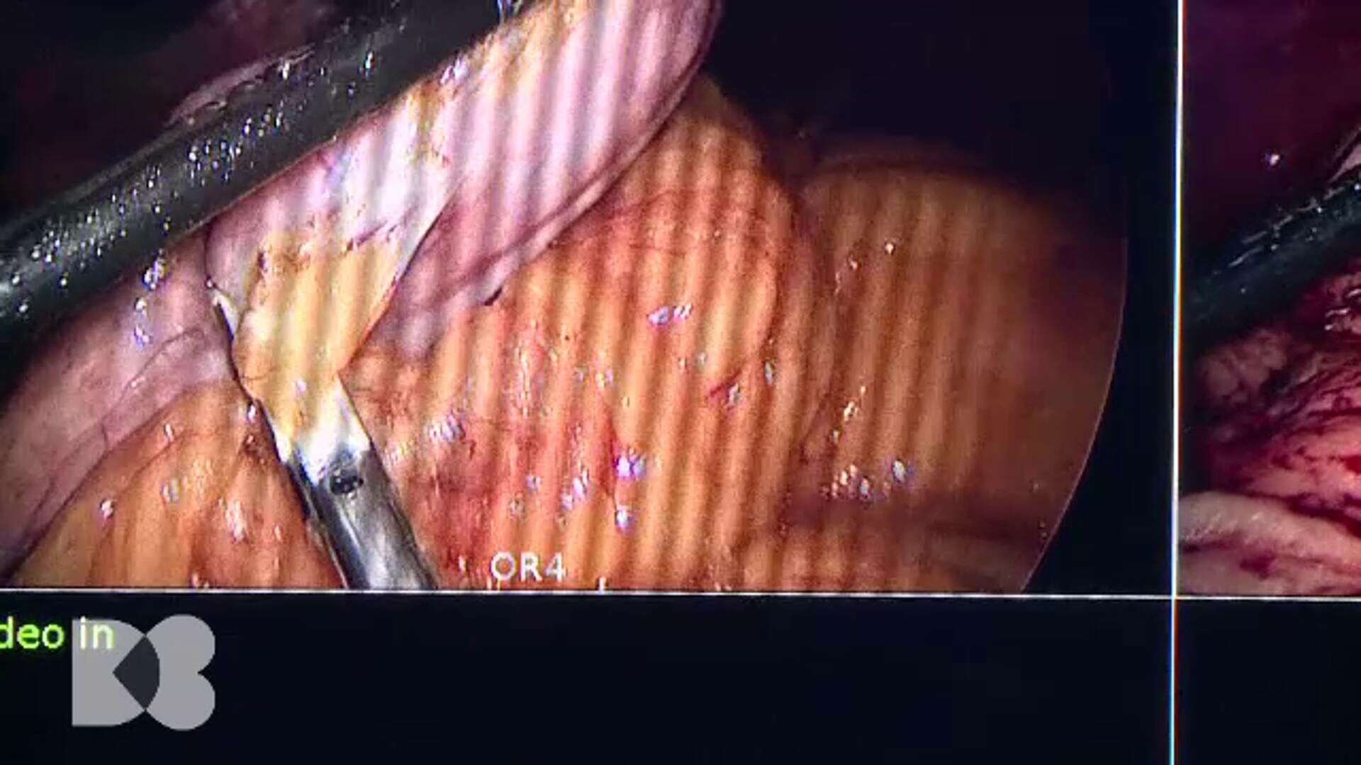 Grăsimea viscerală și impactul asupra sănătății rinichilor și hipertensiunii | sursa foto: Stirile ProTV