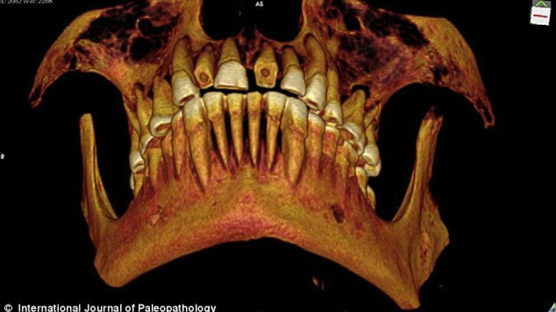 craniu mumie egipteana, dinti