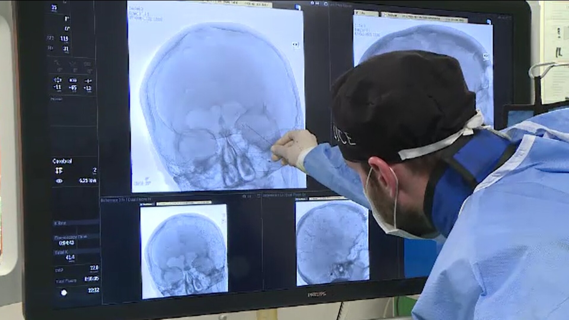 Pastila care triplează riscul de accident vascular cerebral subit la femeile tinere. Ultimele studii prezentate la Helsinki