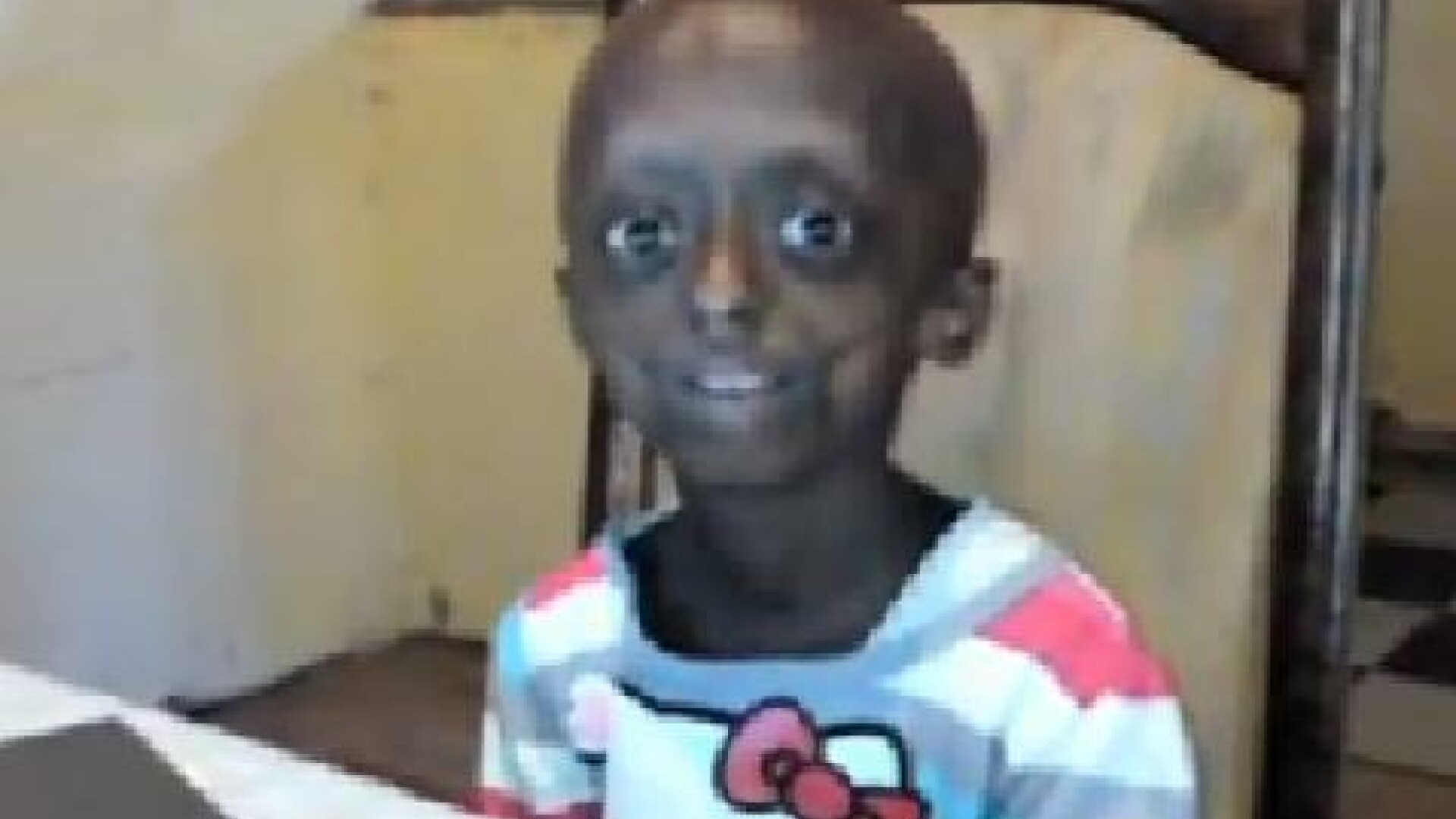 Progeria