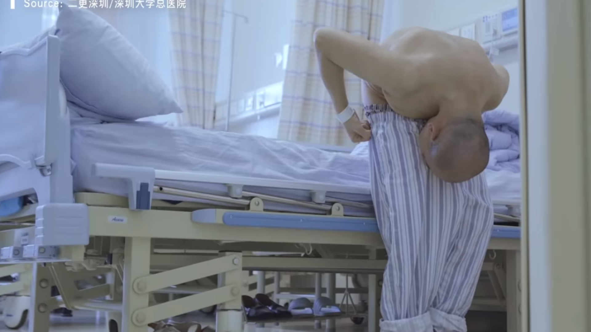 VIDEO. A stat îndoit 28 de ani, din cauza spondilitei. Cum arată după ce medicii au reușit să-i îndrepte coloana