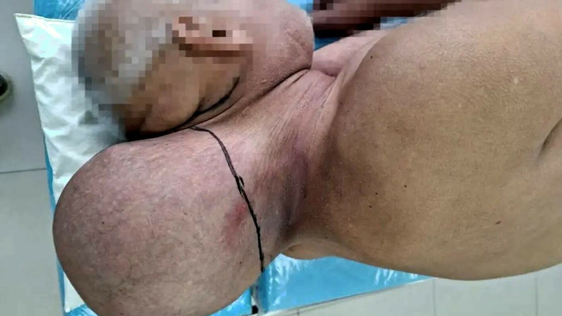 tumoare barbat rusia extirpata