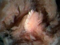 TYRANNOBDELLA REX. O lipitoare cu opt dinti, scoasa din nasul unei fete!