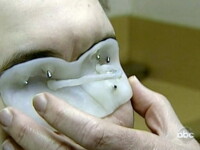 Fata cu jumatate de faţă! Afla-i povestea incredibila! VIDEO