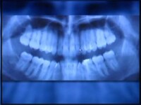 Radiografii Dentare