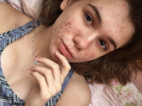 Adolescenta cu acnee