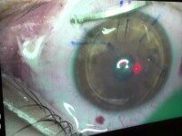 Cum se poate corecta miopia și când nu se recomandă operația cu laser