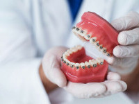 (P) Sfaturi pentru îngrijirea corectă a aparatului dentar