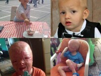 Alex, baietelul de 3 ani desfigurat de arsuri, operat din nou in Turcia. Chipul lui, reconstruit dupa mai multe interventii
