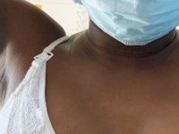 Unei femei a început să îi curgă lapte din axilă. Ce au descoperit medicii