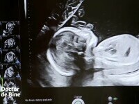 O infecție fără simptome nu le mai permite femeilor să aibă copii pe cale naturală. Testul care trebuie făcut anual