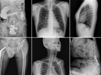 Una din trei radiografii e inutila. Cum scapam de iradierile fara rost?