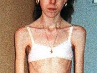 anorexic