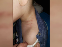 Copil de 3 ani, agresat la o grădiniță din Focșani. Părinții au descoperit urme de degete pe gâtul lui