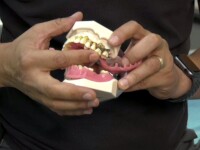 Glicemia mare și fumatul agravează parodontoza. Cum poate fi stopată fără operație