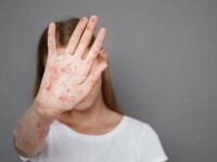 Reapariția rujeolei în Spania. Experții atribuie creșterea cazurilor migranților nevaccinați din Maroc și România