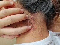 Cum se transmite și cât de periculoasă este lepra. „Tratamentul poate dura între 6 și 12 luni”