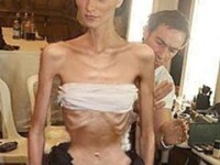 anorexice