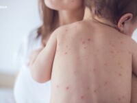 Aproape 10.100 de persoane nevaccinate, confirmate cu rujeolă de la începutul epidemiei