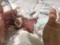 Cel mai mic bebeluș de sex masculin din lume a avut la naștere 268 de grame