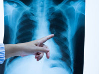 Cum pot fi depistate și evaluate leziunile pulmonare lăsate de infecția COVID-19?