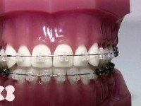 Aparatele dentare pot fi controlate printr-o aplicație. Când e necesar să mergi la medicul ortodont