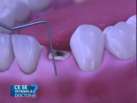 Pierderea dintilor nu este cauzata doar de carii. Ce trebuie sa faci dupa o extractie dentara