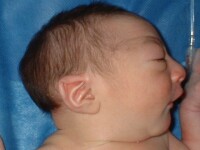 copil cu microcefalie