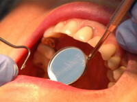 Acuzatii extrem de grave: un implant dentar a bagat-o in groapa!