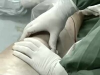 Un chirurg şi-a scris iniţialele cu laser pe ficatul pacienţilor pe care i-a operat